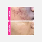 Gel Clareador Antiacne - Ácido Mandélico - Imagem 5